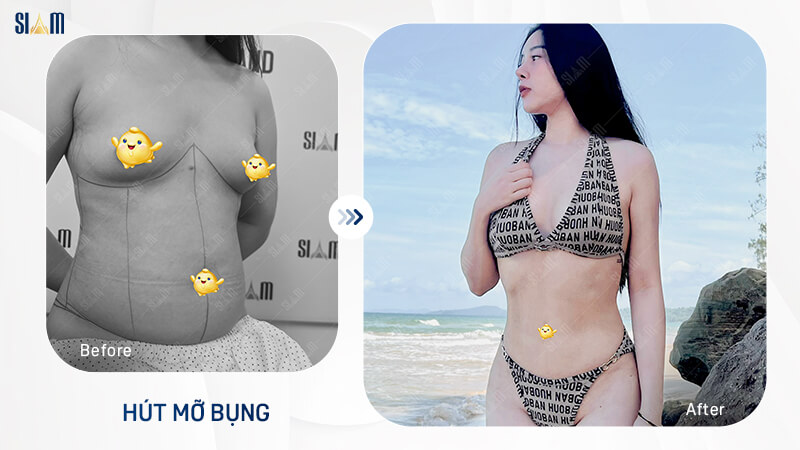 Khách hàng tự tin diện bikini sau khi phẫu thuật hút mỡ bụng tại Siam