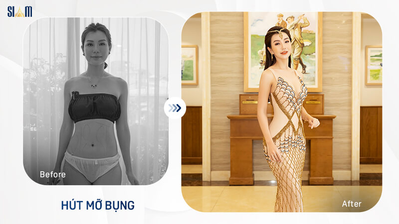 Khách hàng tự tin diện trang phục body sau khi hút mỡ bụng tại Siam