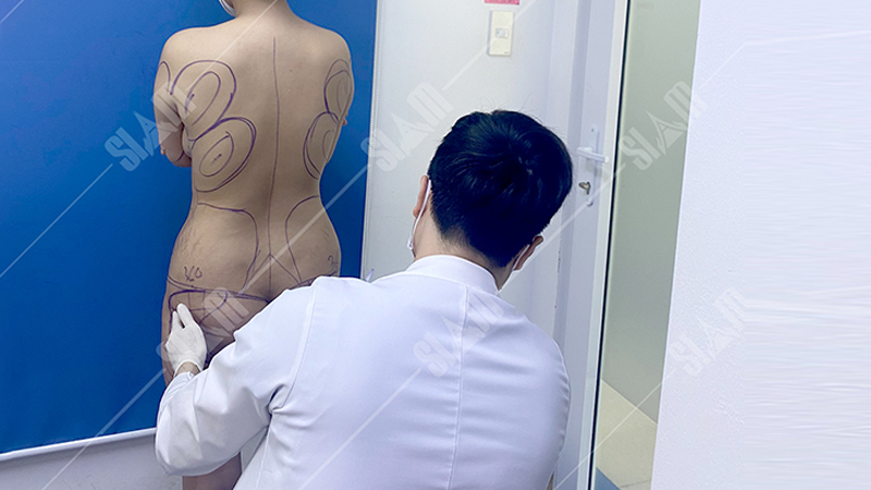 Bác sĩ tiến hành đo vẽ cho khách hàng trước khi tiến hàng hút mỡ cấy mông