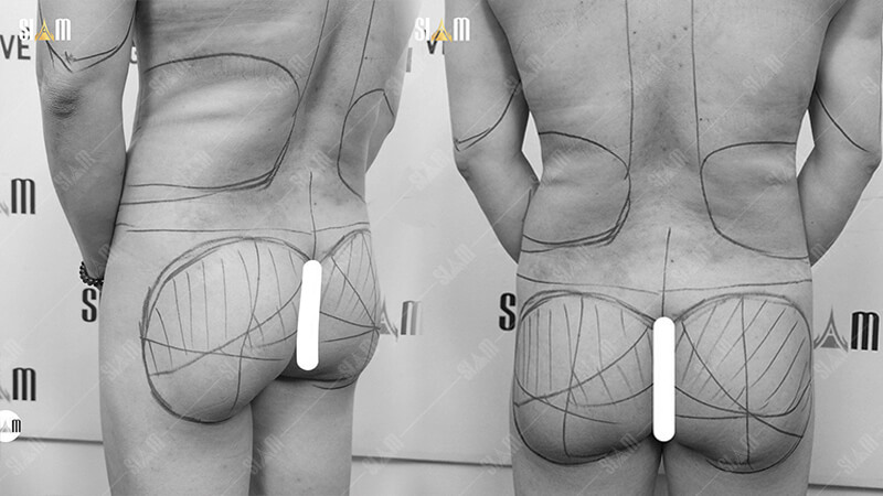 Khách hàng có mông nhỏ hoặc chảy xệ, mông phẳng nên thực hiện hút mỡ cấy mông