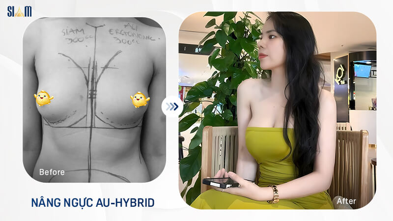 Khách hàng sở hữu vòng 1 căng tròn sau phẫu thuật nâng ngực Au-hybrid