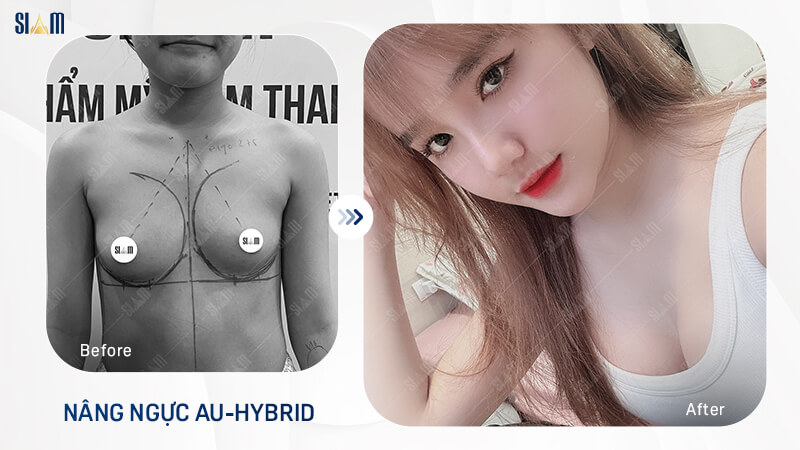 Khách hàng hài lòng với dịch vụ nâng ngực Au-hybrid tại Siam