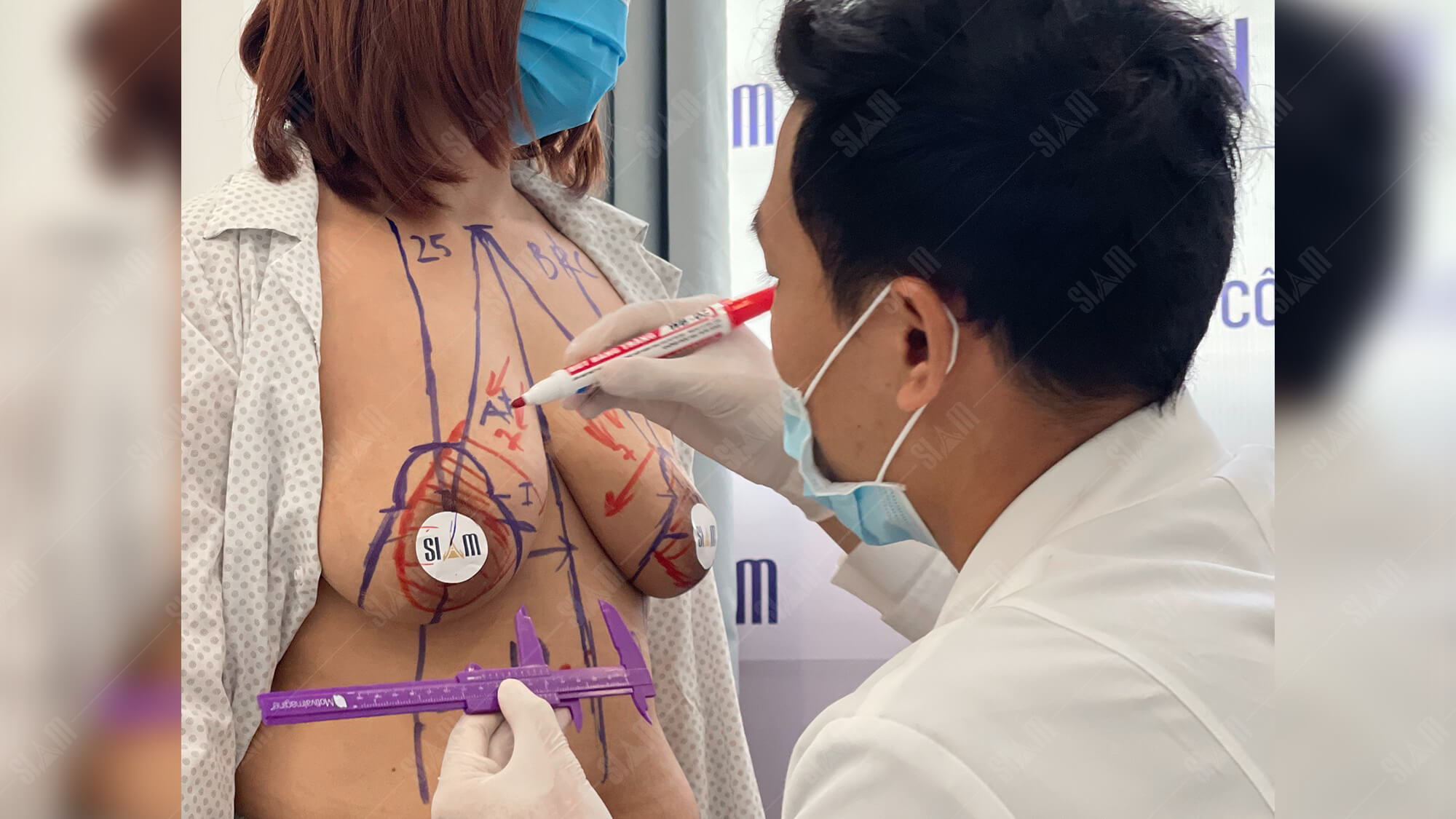 Hình ảnh bác sĩ đo vẽ ngực cho khách hàng trước khi phẫu thuật treo sa trễ