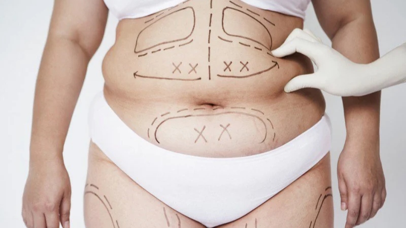 Phẫu thuật béo phì là lựa chọn cho những người có BMI cao