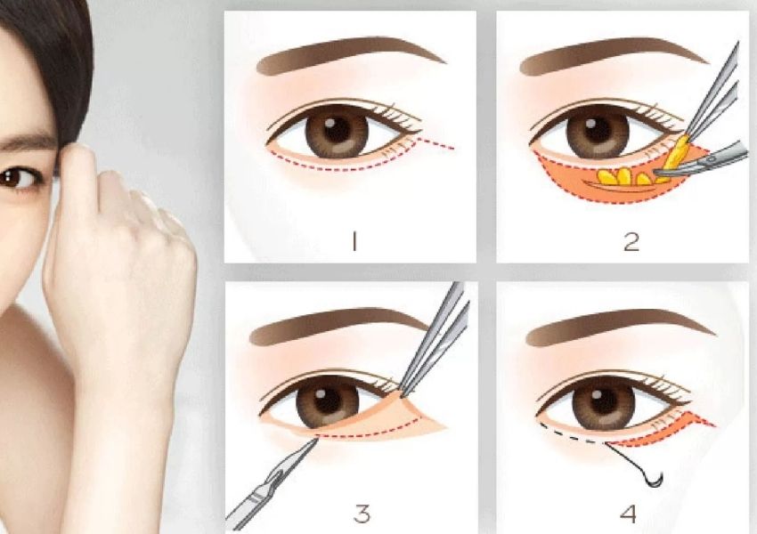 Phương pháp bóc mỡ mắt mini tại Siam 