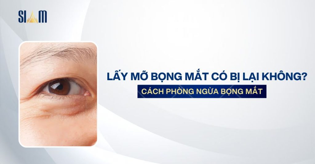 Lấy mỡ bọng mắt có bị lại không