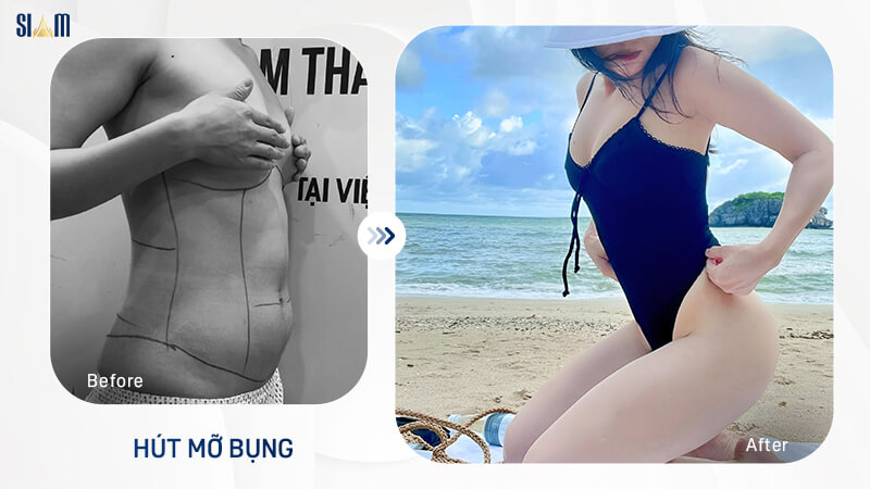 Kết quả thẩm mỹ sau hút mỡ bụng tại SIAM Thailand